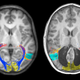 MRI muestra un cerebro normal (izquierda) y el del niño australiano (derecha). Inaki-Carril Mundinano et al